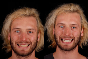 Side-by-side portraits highlight HiSmile's dazzling results.